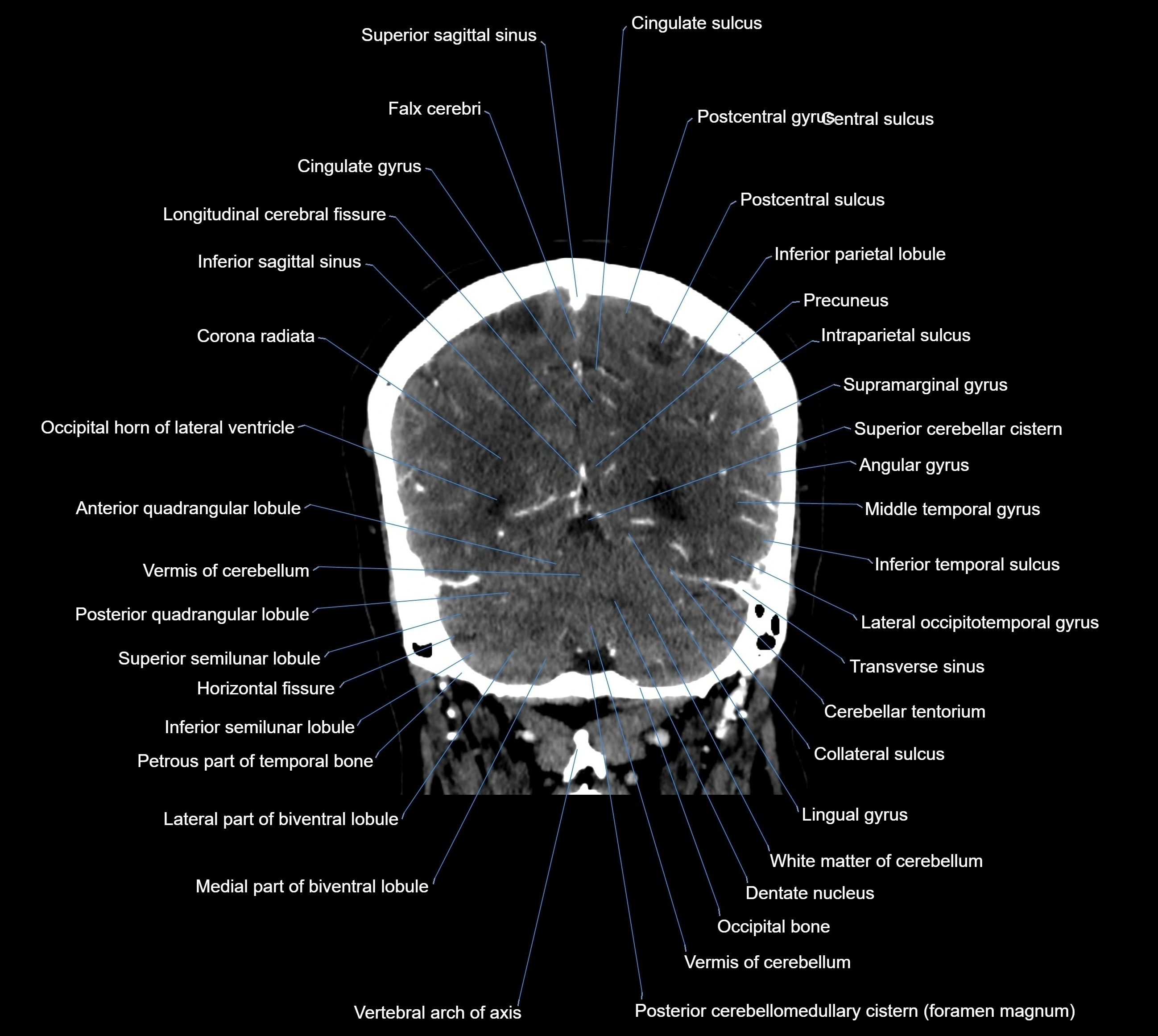 CT Brain coronal cross sectional radiology anatomy image  -img-00001-035.webp